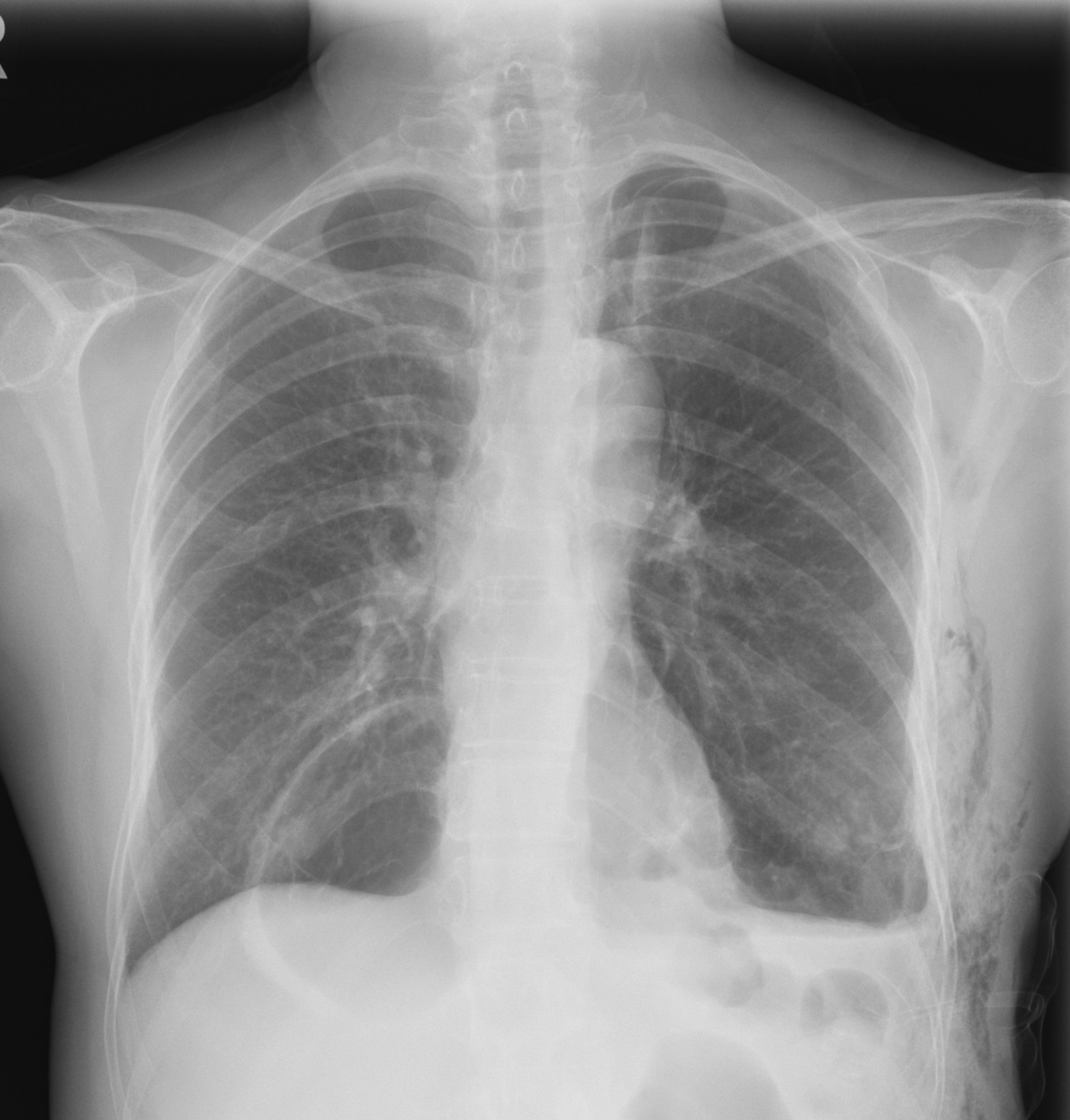 Figure 2. CXR after insertion and removal of chest drain